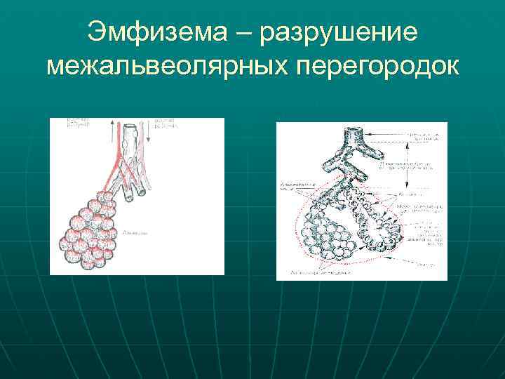 Эмфизема – разрушение межальвеолярных перегородок 