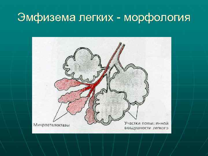 Эмфизема легких - морфология 