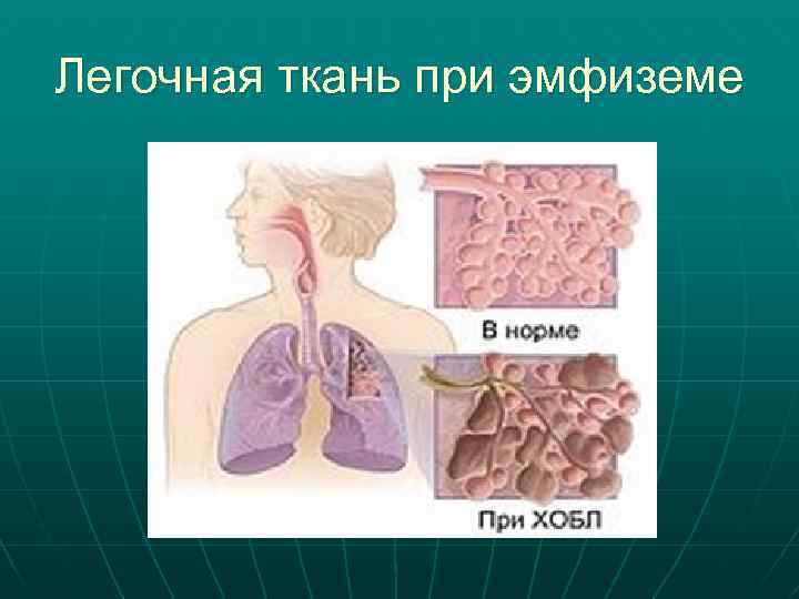 Легочная ткань при эмфиземе 