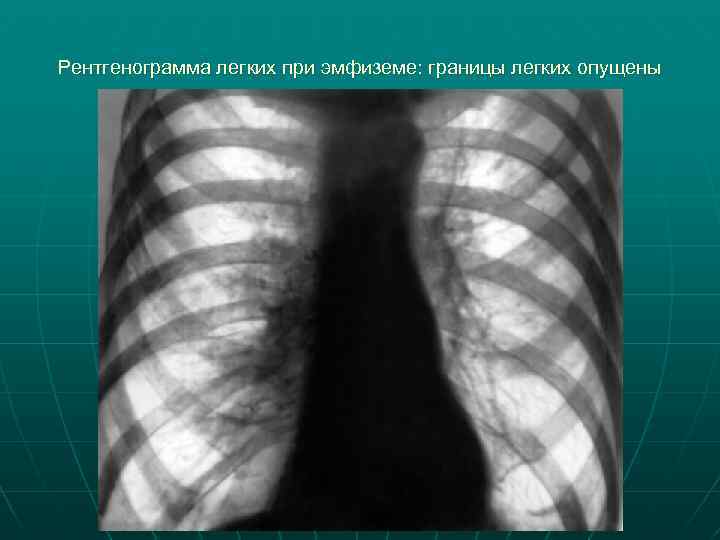 Рентгенограмма легких при эмфиземе: границы легких опущены 