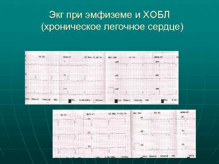 Экг при эмфиземе и ХОБЛ (хроническое легочное сердце) 