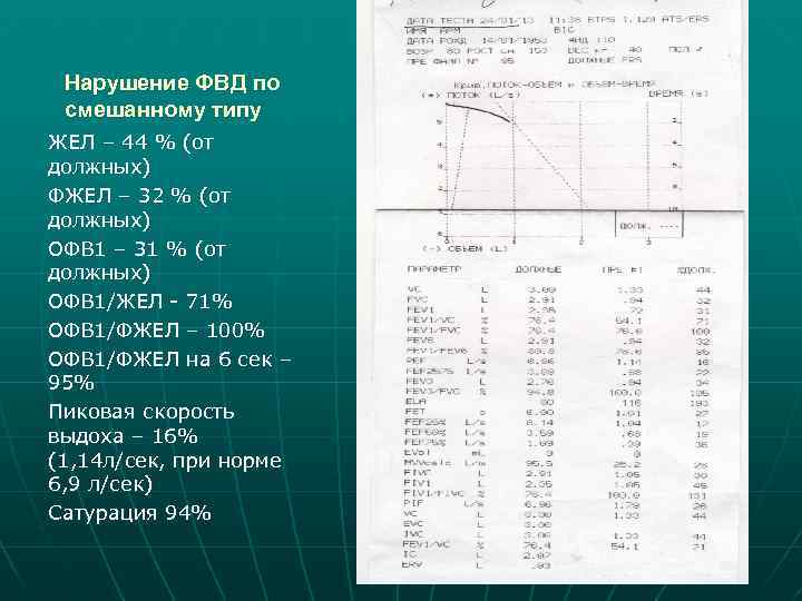 Нарушение ФВД по смешанному типу ЖЕЛ – 44 % (от должных) ФЖЕЛ – 32