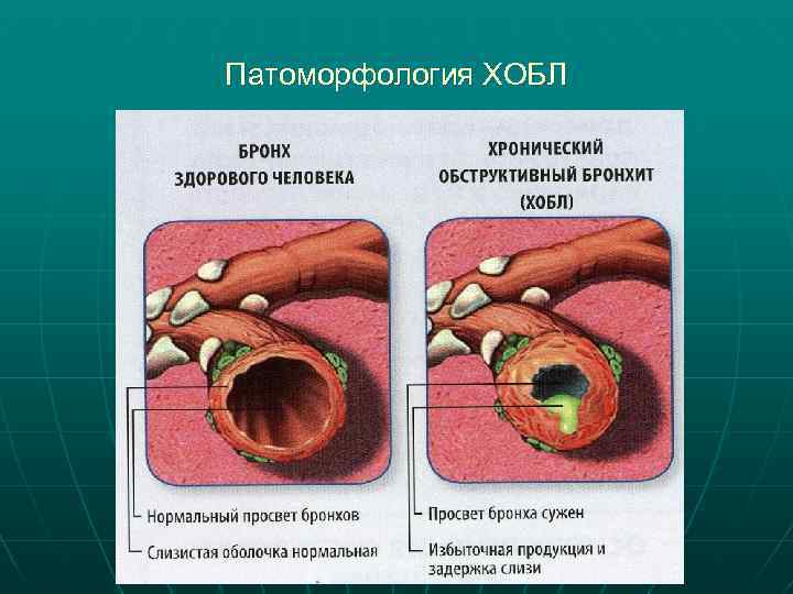 Патоморфология ХОБЛ 