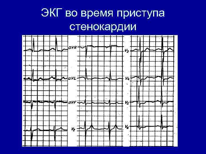 ЭКГ во время приступа стенокардии 