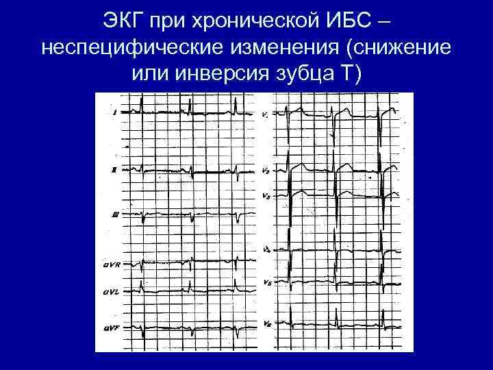 ЭКГ при хронической ИБС – неспецифические изменения (снижение или инверсия зубца Т) 
