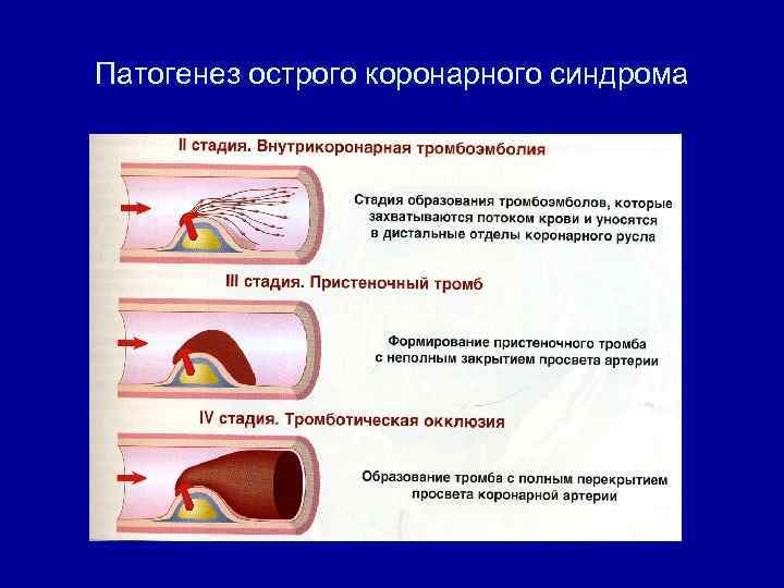 Патогенез острого коронарного синдрома 