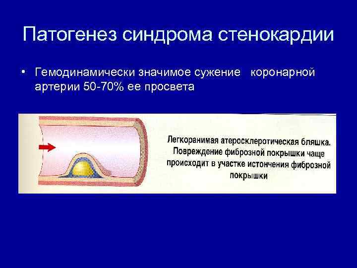 Патогенез синдрома стенокардии • Гемодинамически значимое сужение коронарной артерии 50 -70% ее просвета 