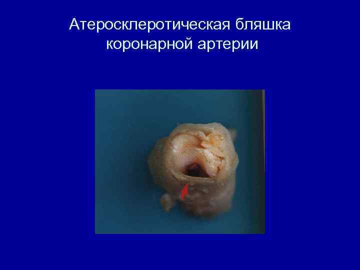 Атеросклеротическая бляшка коронарной артерии 