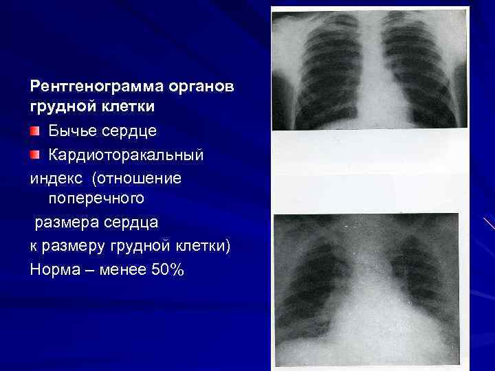 Рентгенограмма органов грудной клетки Бычье сердце Кардиоторакальный индекс (отношение поперечного размера сердца к размеру