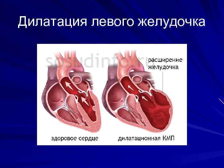 Дилатация левого желудочка 