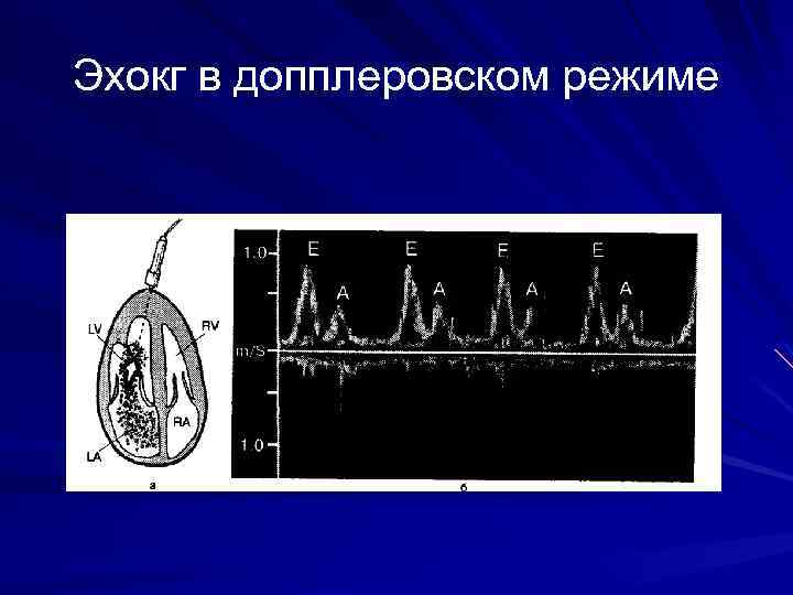 Эхокг в допплеровском режиме 