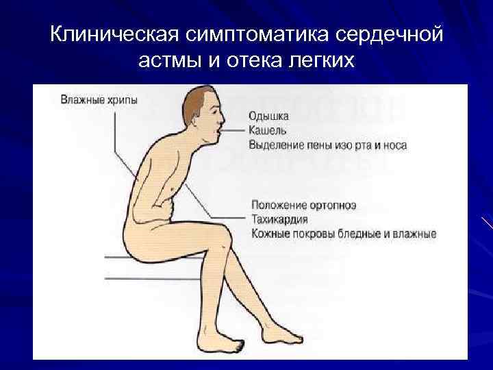 Клиническая симптоматика сердечной астмы и отека легких 