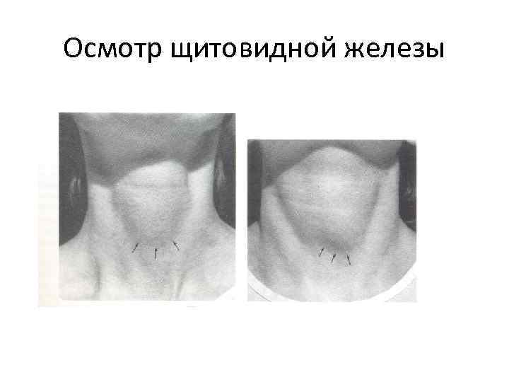 Осмотр щитовидной железы 