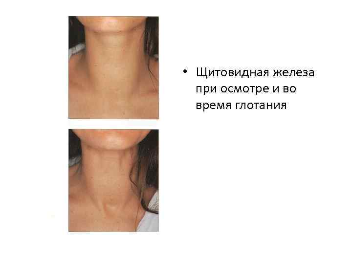  • Щитовидная железа при осмотре и во время глотания 