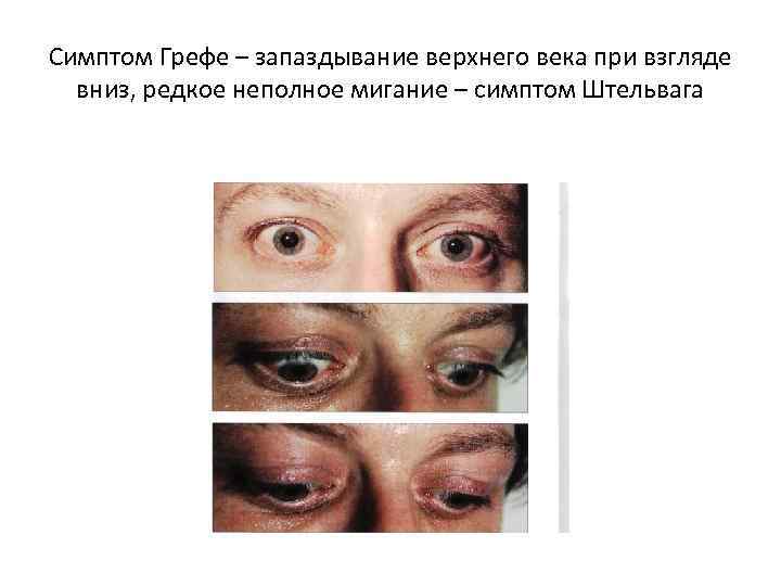 Симптом Грефе – запаздывание верхнего века при взгляде вниз, редкое неполное мигание – симптом