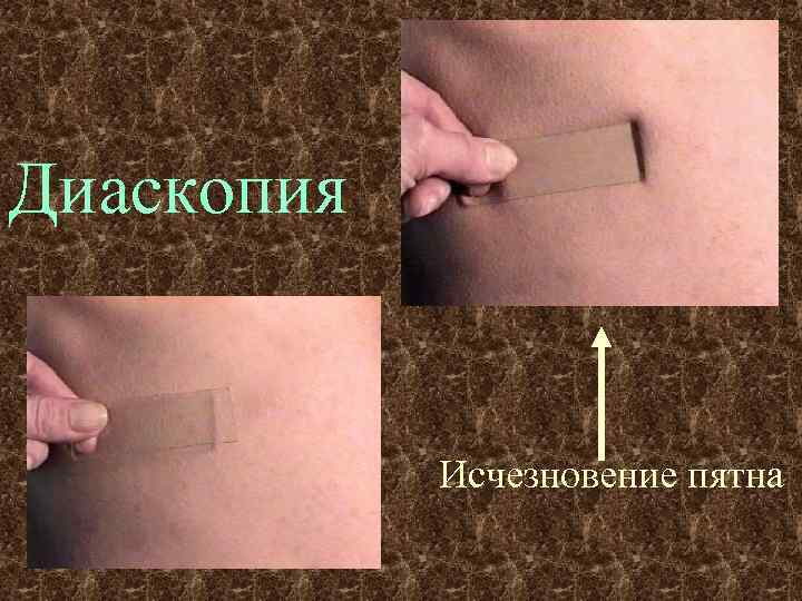 Диаскопия Исчезновение пятна 