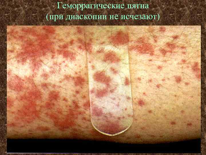 Геморрагические пятна (при диаскопии не исчезают) 