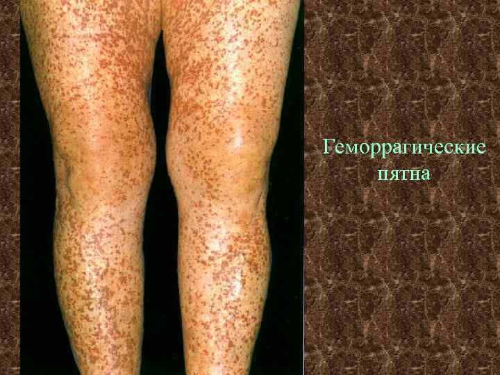 Геморрагические пятна 