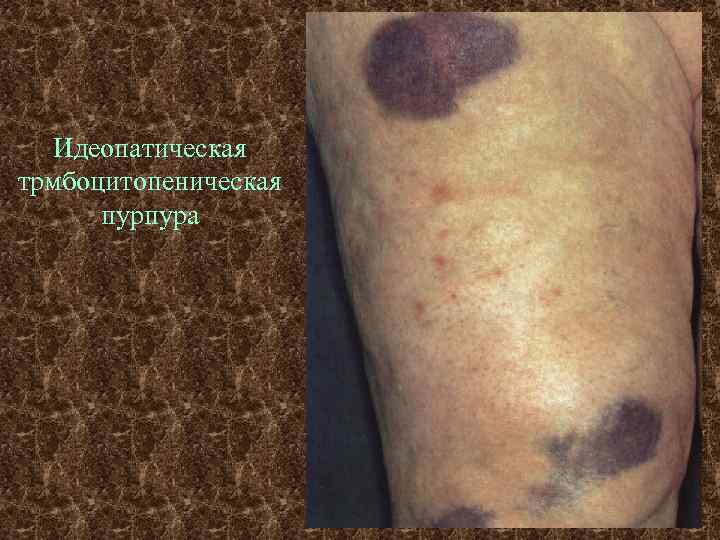 Идеопатическая трмбоцитопеническая пурпура 
