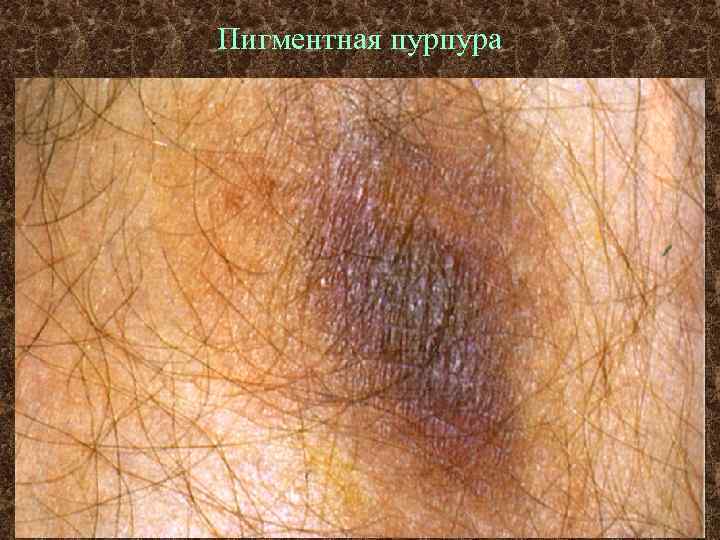 Пигментная пурпура 