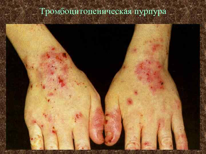 Тромбоцитопеническая пурпура 