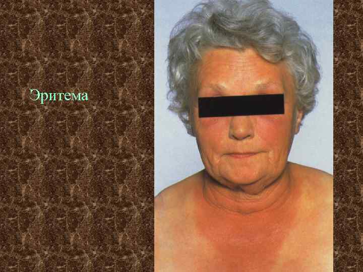 Эритема 