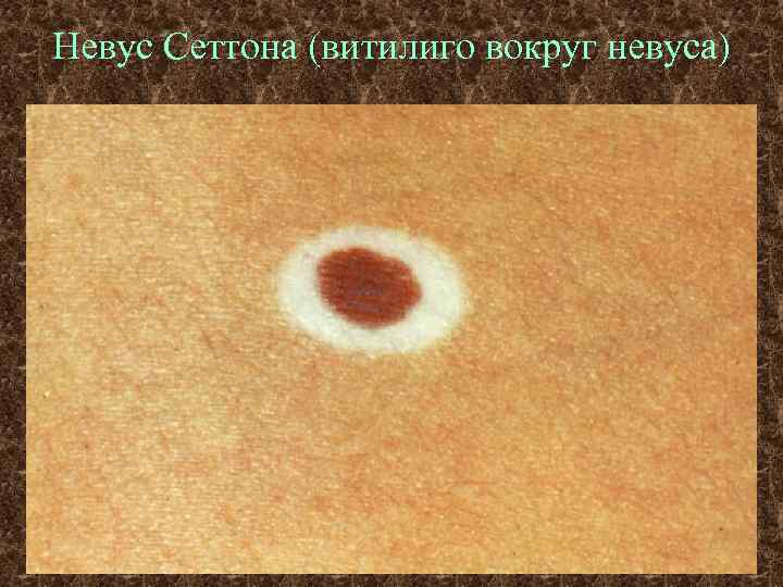Невус Сеттона (витилиго вокруг невуса) 