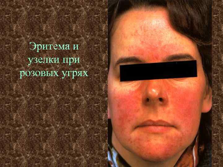 Эритема и узелки при розовых угрях 