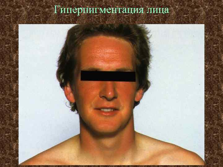 Гиперпигментация лица 