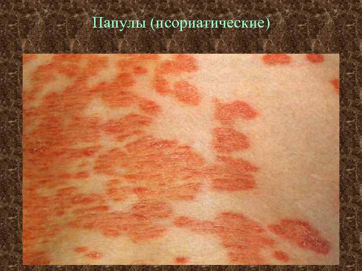 Папулы (псориатические) 