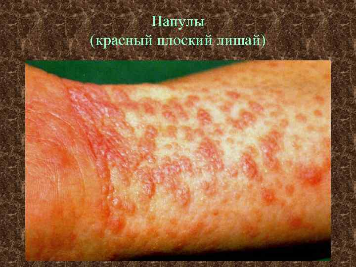 Папулы (красный плоский лишай) 