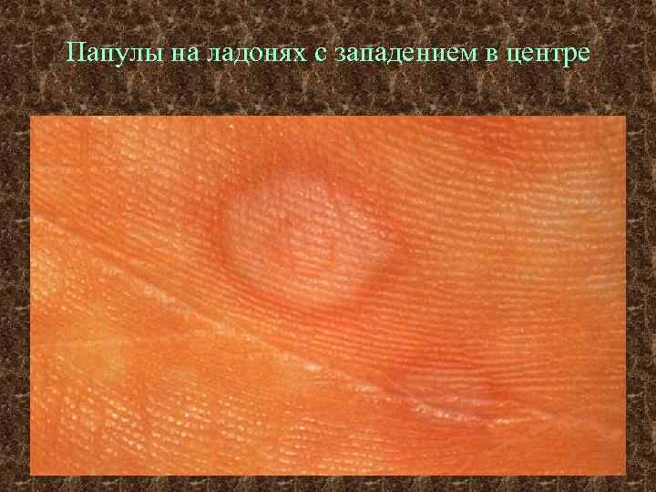 Папулы на ладонях с западением в центре 