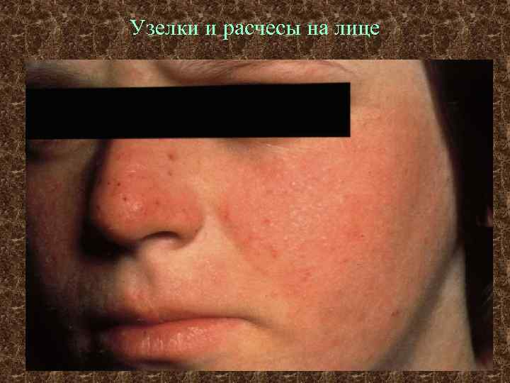 Узелки и расчесы на лице 