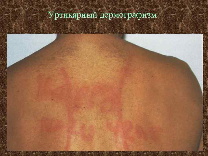Уртикарный дермографизм 