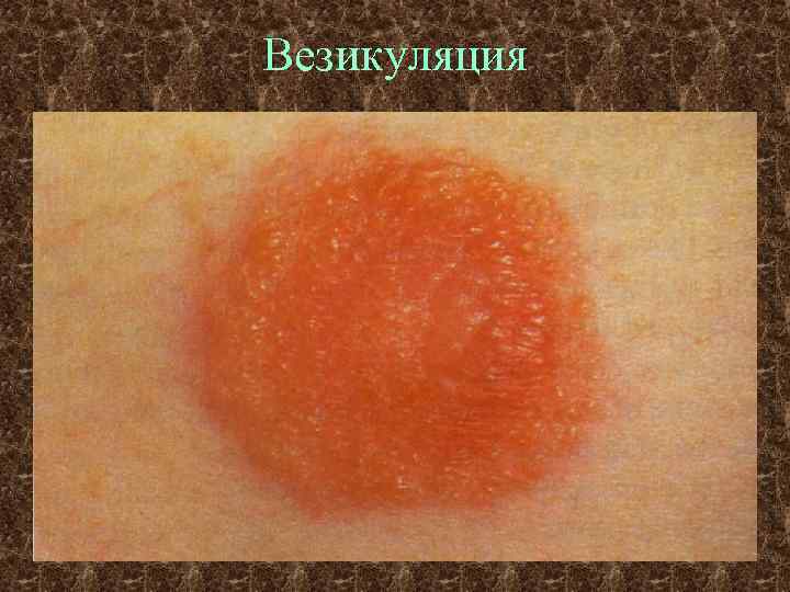 Везикуляция 