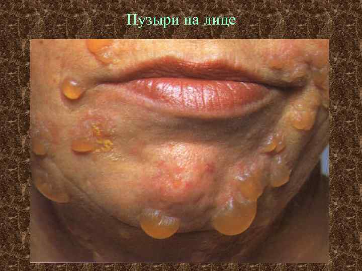 Пузыри на лице 