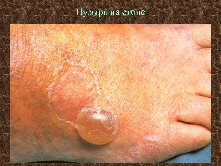Пузырь на стопе 