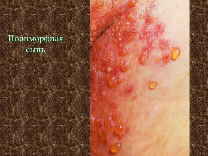Полиморфная сыпь 