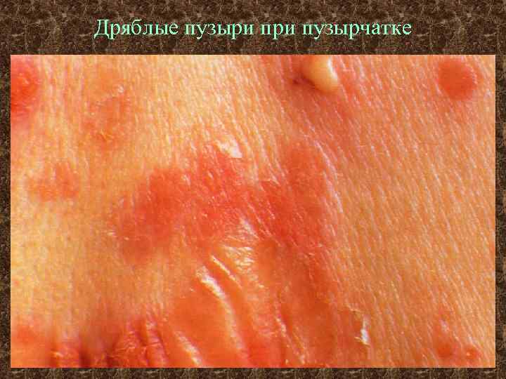 Дряблые пузыри пузырчатке 