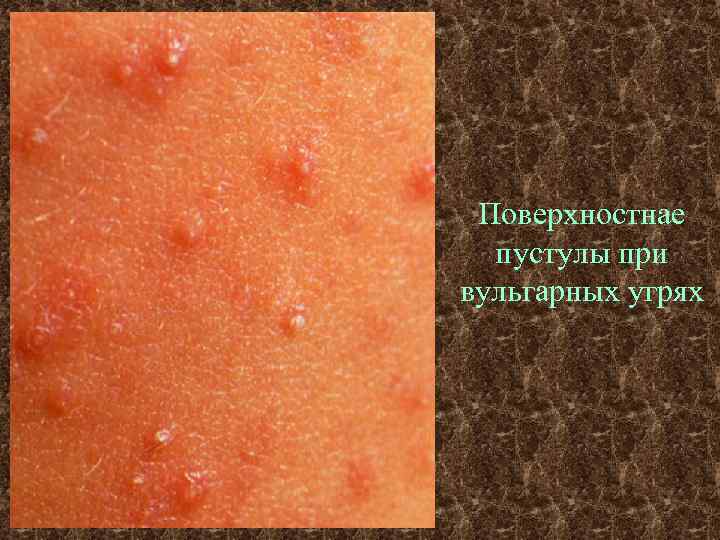 Поверхностнае пустулы при вульгарных угрях 