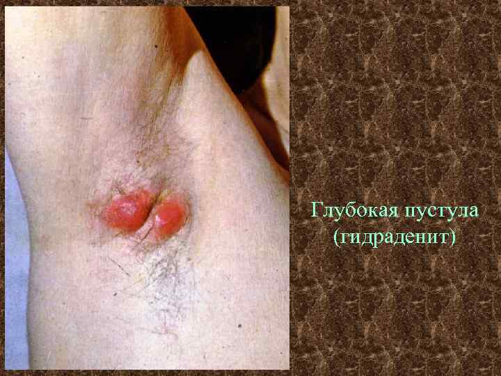Глубокая пустула (гидраденит) 