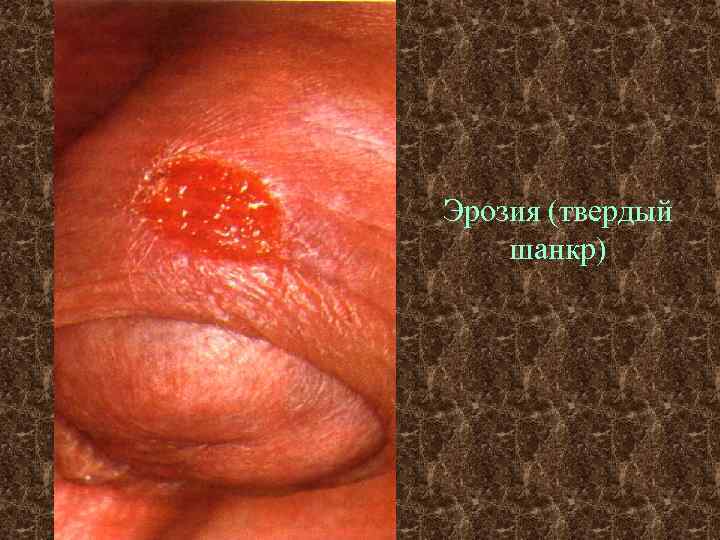 Эрозия (твердый шанкр) 