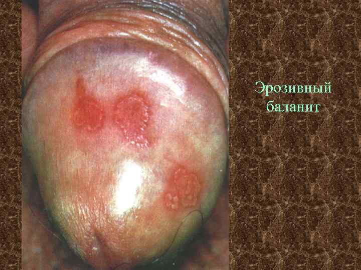 Эрозивный баланит 