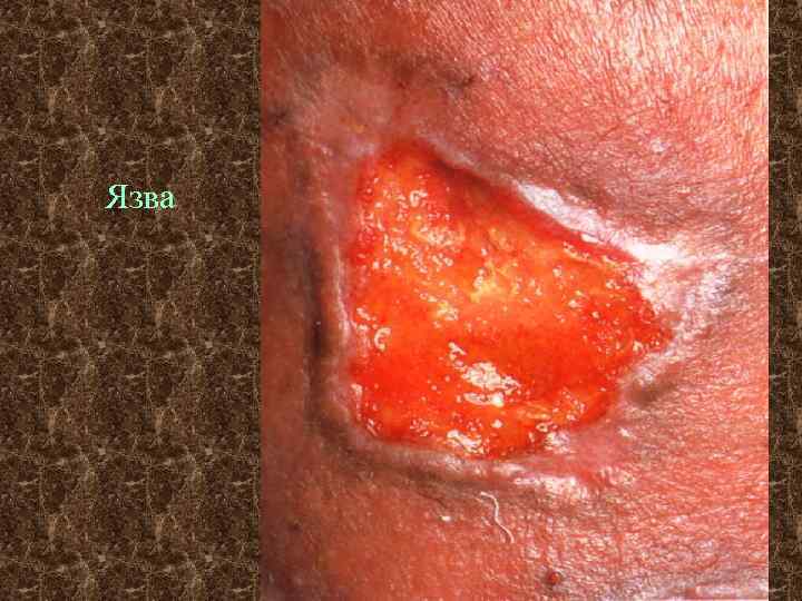 Язва 