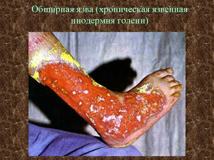 Обширная язва (хроническая язвенная пиодермия голени) 