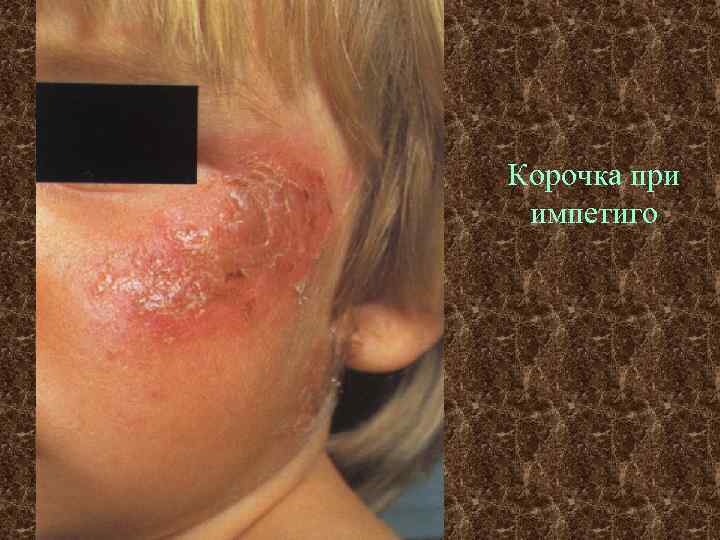 Корочка при импетиго 