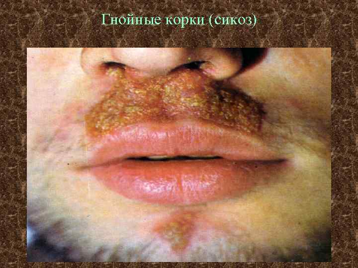 Гнойные корки (сикоз) 