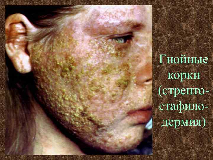 Гнойные корки (стрептостафилодермия) 