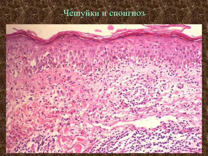Чешуйки и спонгиоз 