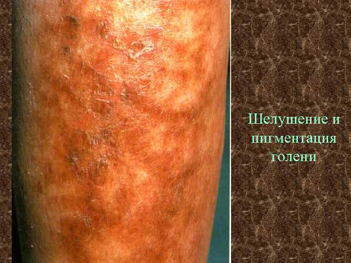 Шелушение и пигментация голени 